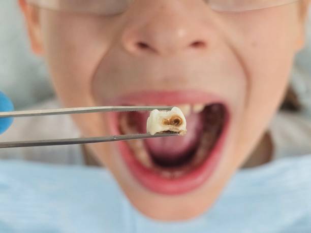 Best Emergency Broken Tooth Repair in Westport, IN